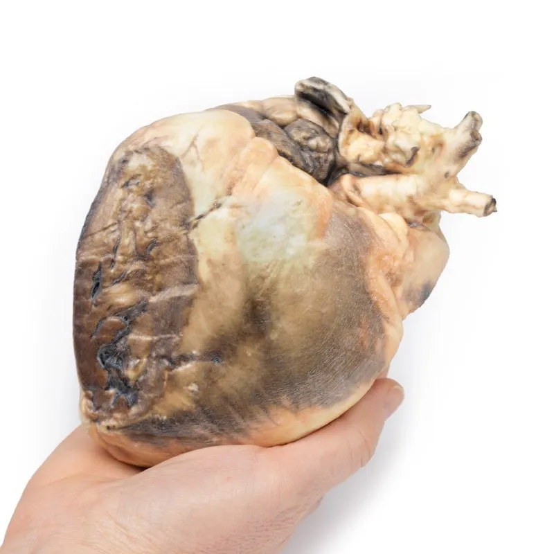 3D Printed Atrial Septal Defect