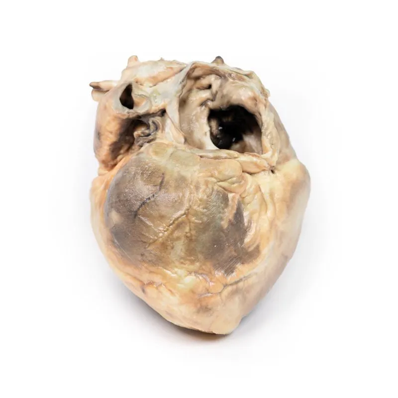 3D Printed Atrial Septal Defect