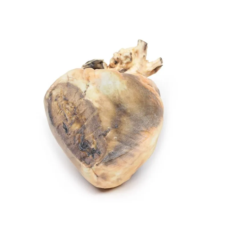 3D Printed Atrial Septal Defect