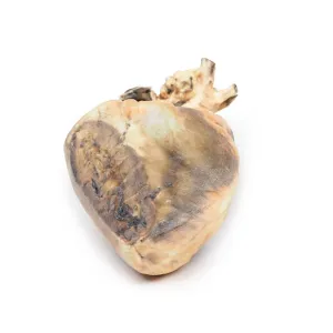 3D Printed Atrial Septal Defect