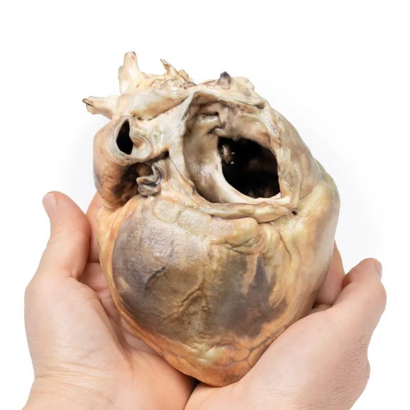 3D Printed Atrial Septal Defect